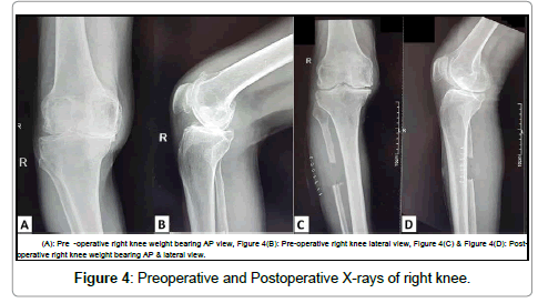 Clinical and Functional Outcomes of Proximal Fibular Osteotomy on