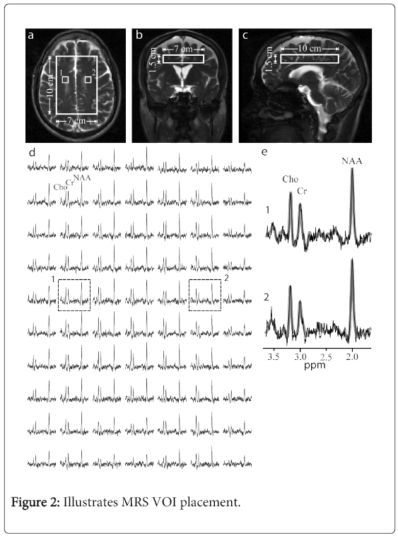 multiple-sclerosis-MRS-VOI